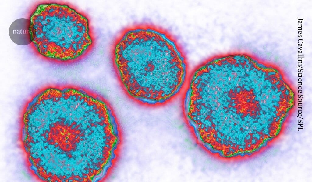 A caxumba está aumentando em alguns países – mas uma nova dose de vacina pode ajudar